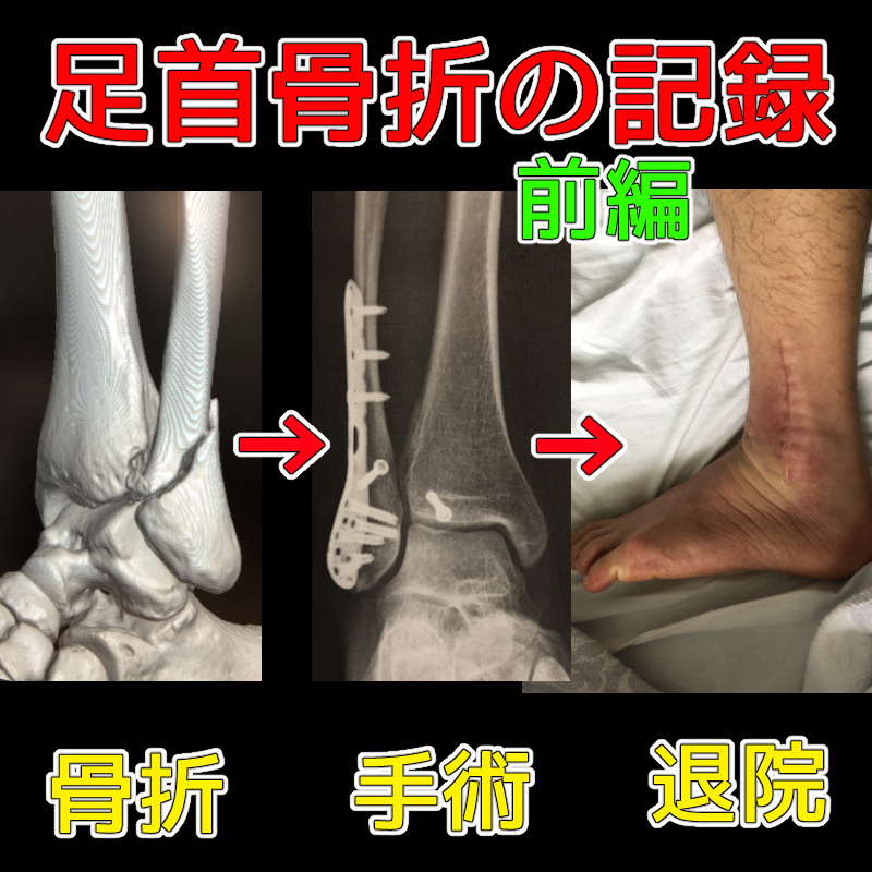 足首 腓骨 骨折の記録21 前編 骨折 手術 退院 鹿児島のkei